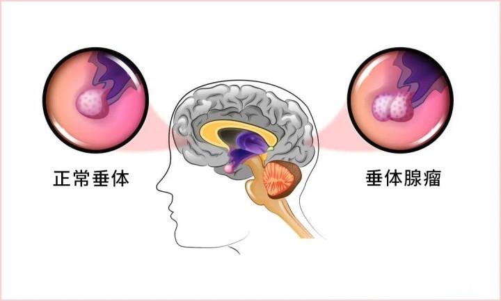 就診指南哪些垂體瘤可以藥物治療哪些垂體瘤手術治療