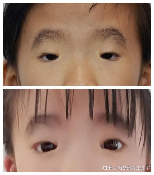 什么是小睑裂综合征?