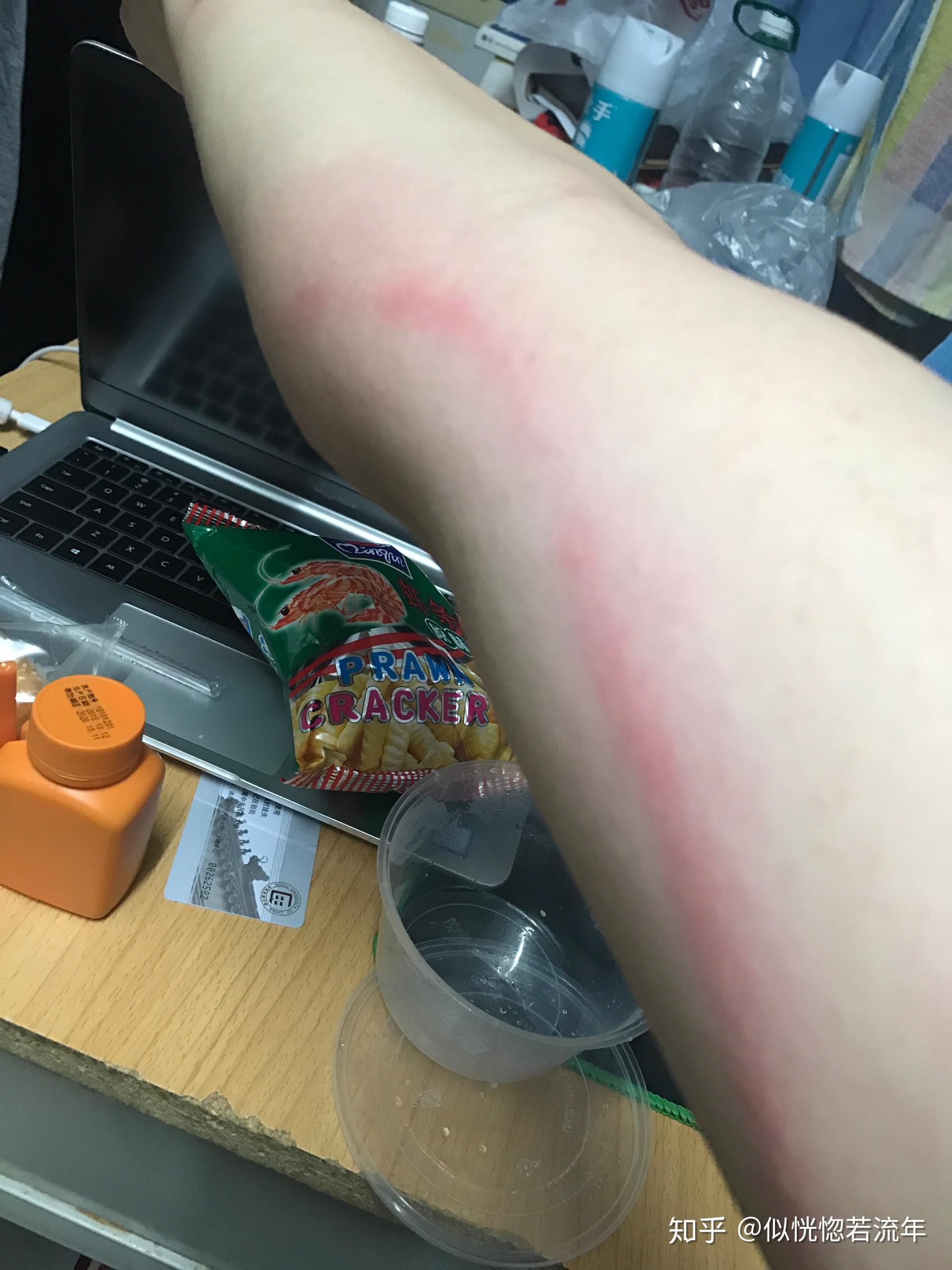 被虫子咬了,胳膊上一条红线往上延伸,这是什么?