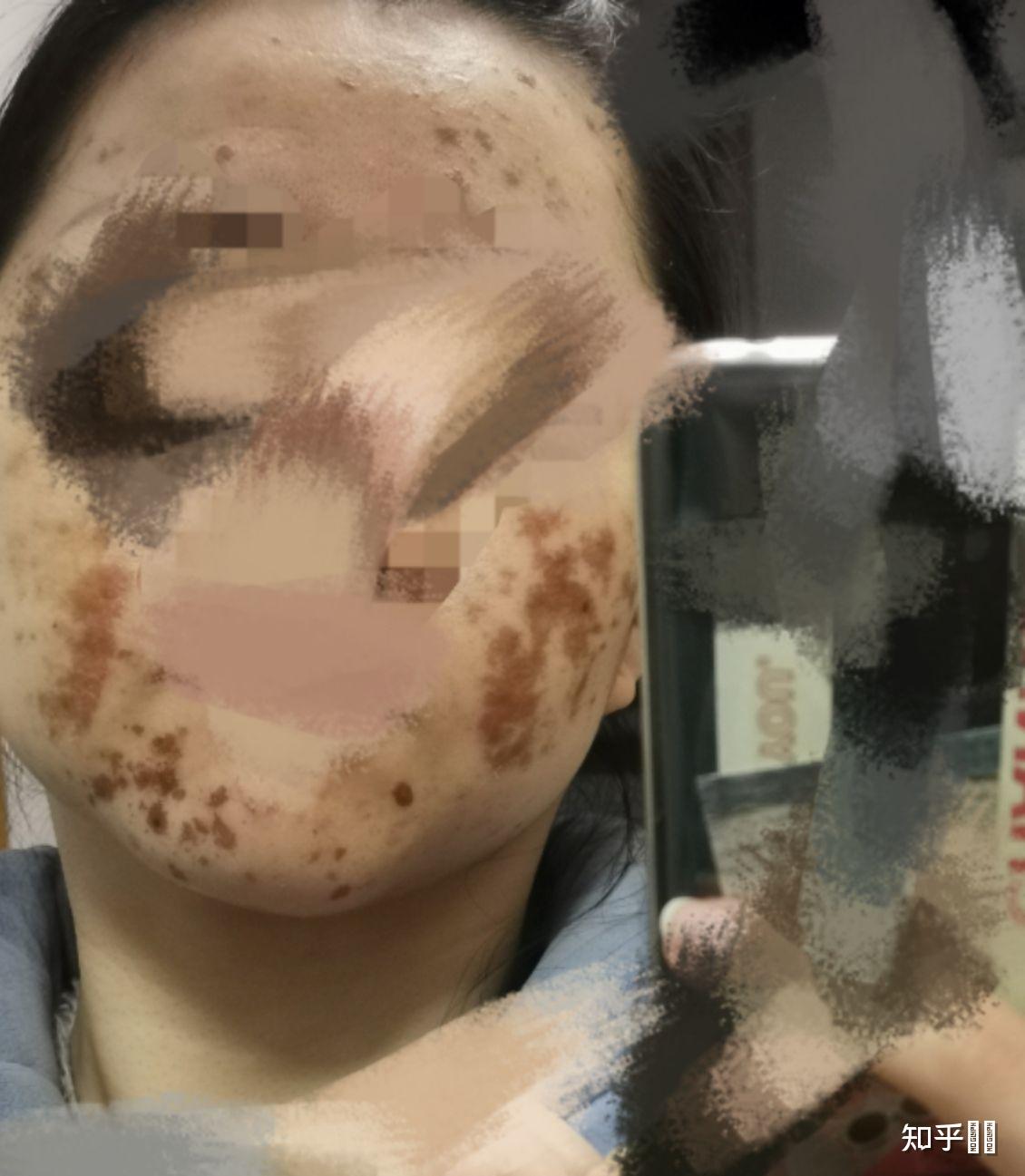 果酸灼伤是什么体验? - 知乎