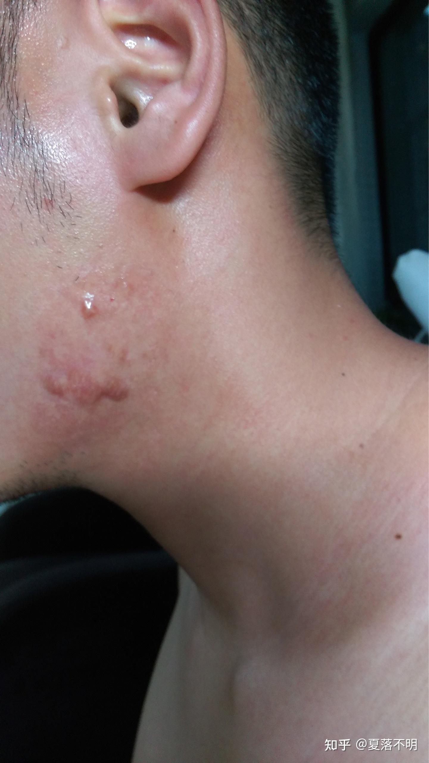 痤疮(痘痘)治疗好后留在两腮淋巴处的增生性痘疤怎么方法好? - 知乎