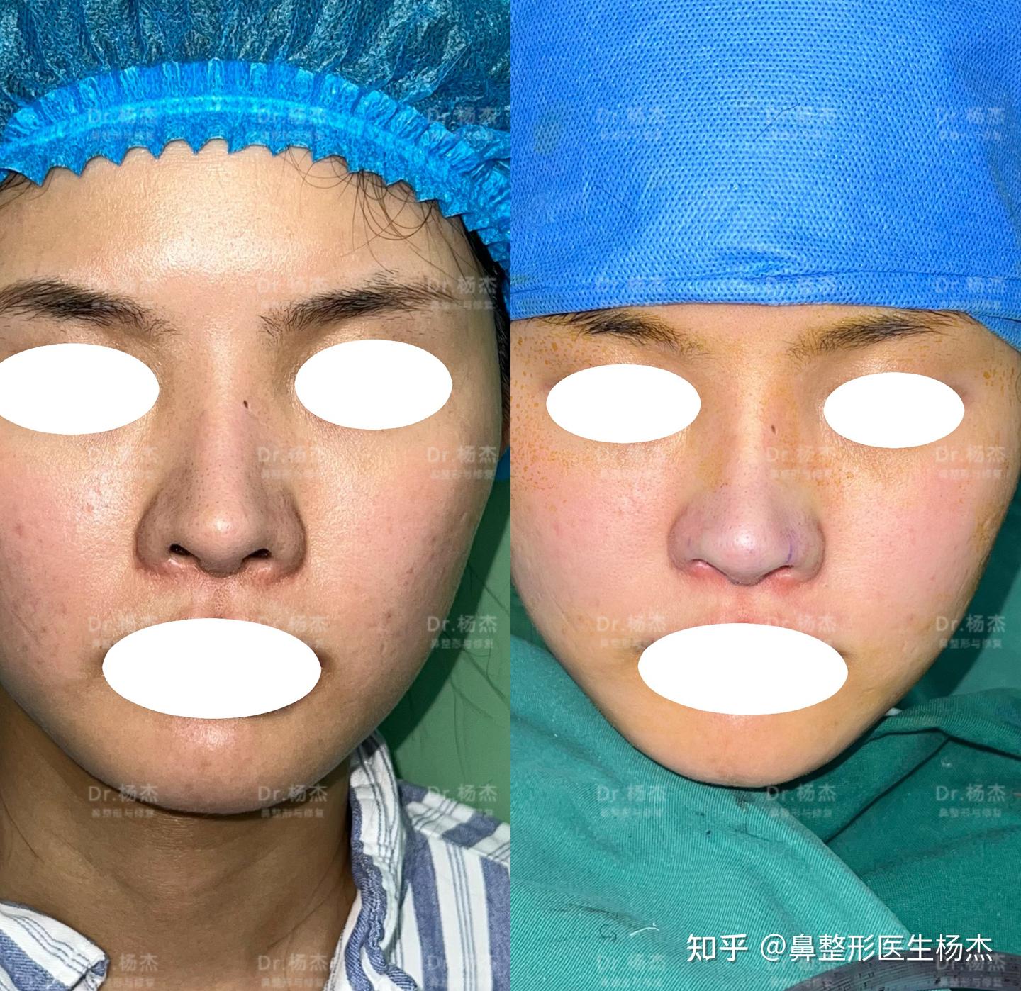 鼻翼缘退缩可以不做鼻综合单独下拉吗? - 知乎