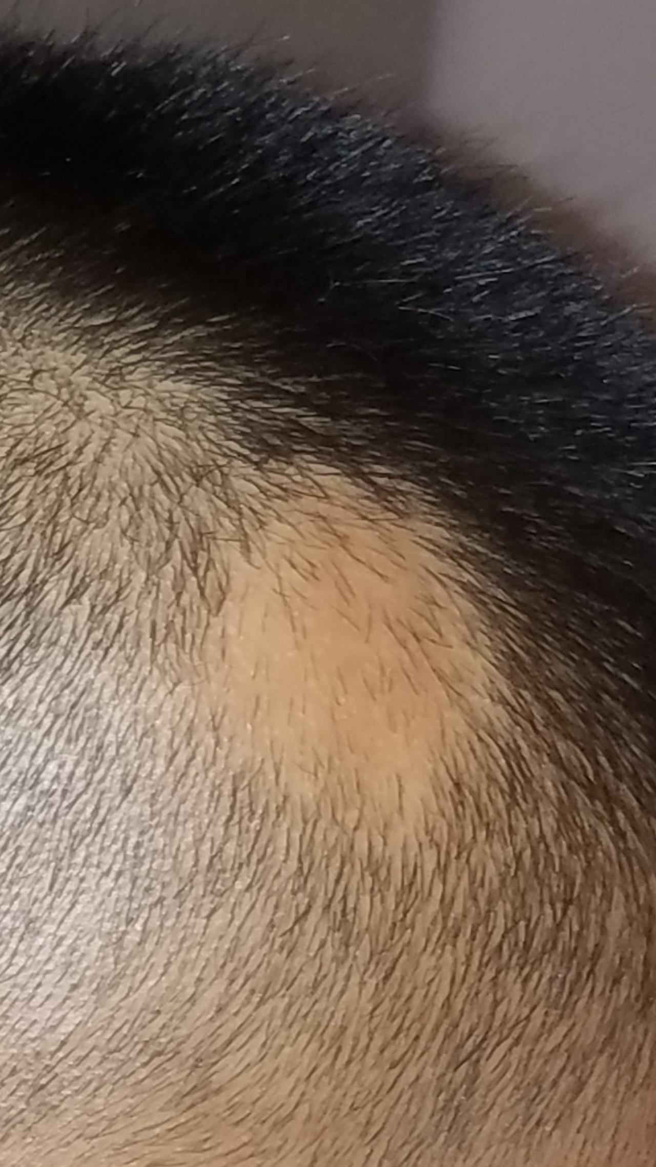 斑秃三个月了,有变大的趋势,怎么根治呢.求帮忙?