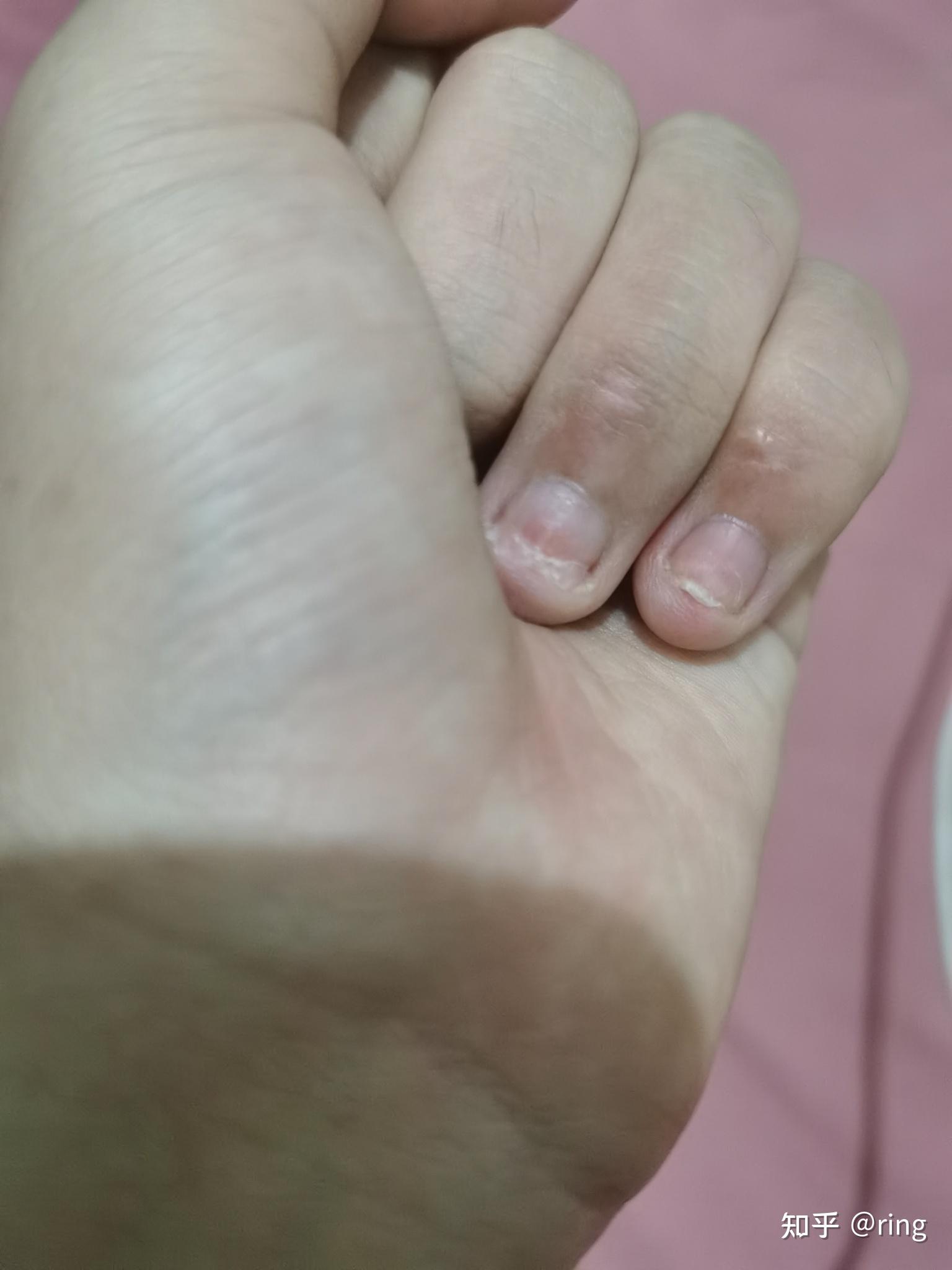手指甲前端有血丝，一碰还很疼，是怎么回事，过段时间指甲长出来，血丝也跟着长出来了。_百度知道