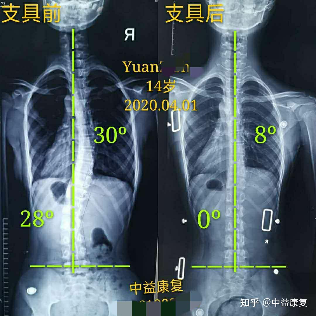 全国脊柱侧弯支具哪里做的好?