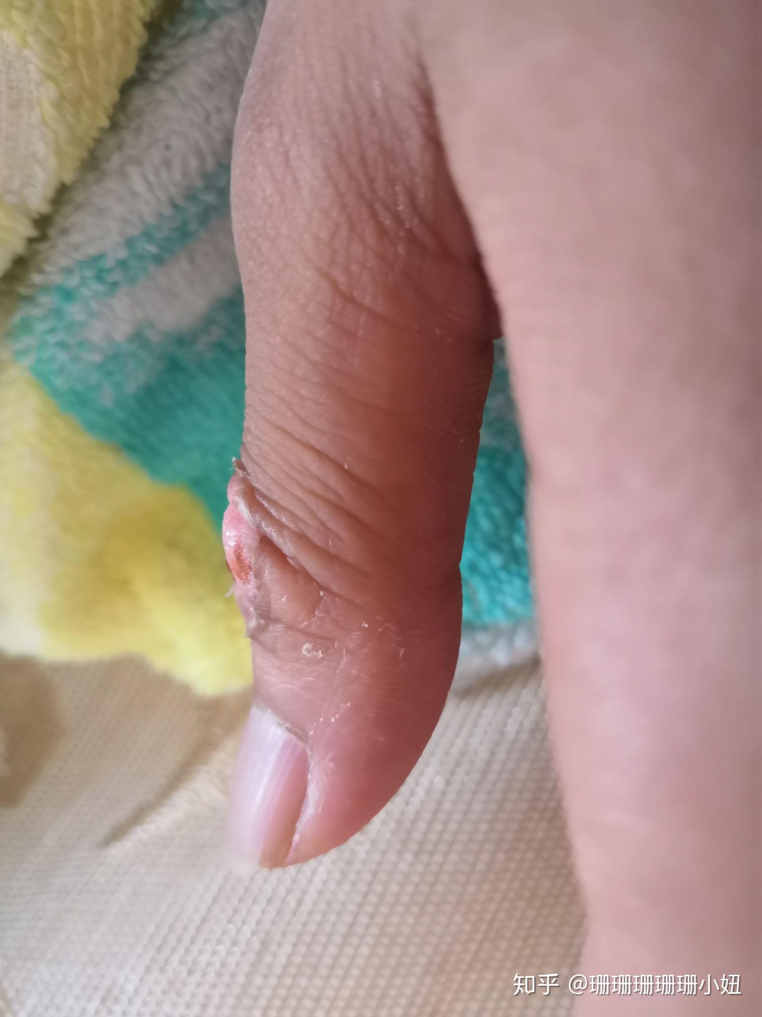 手部关节指垫怎么治疗