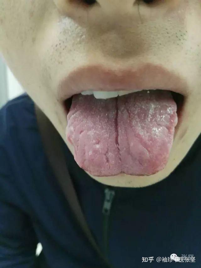 珍贵的舌诊图谱(收藏版) - 知乎