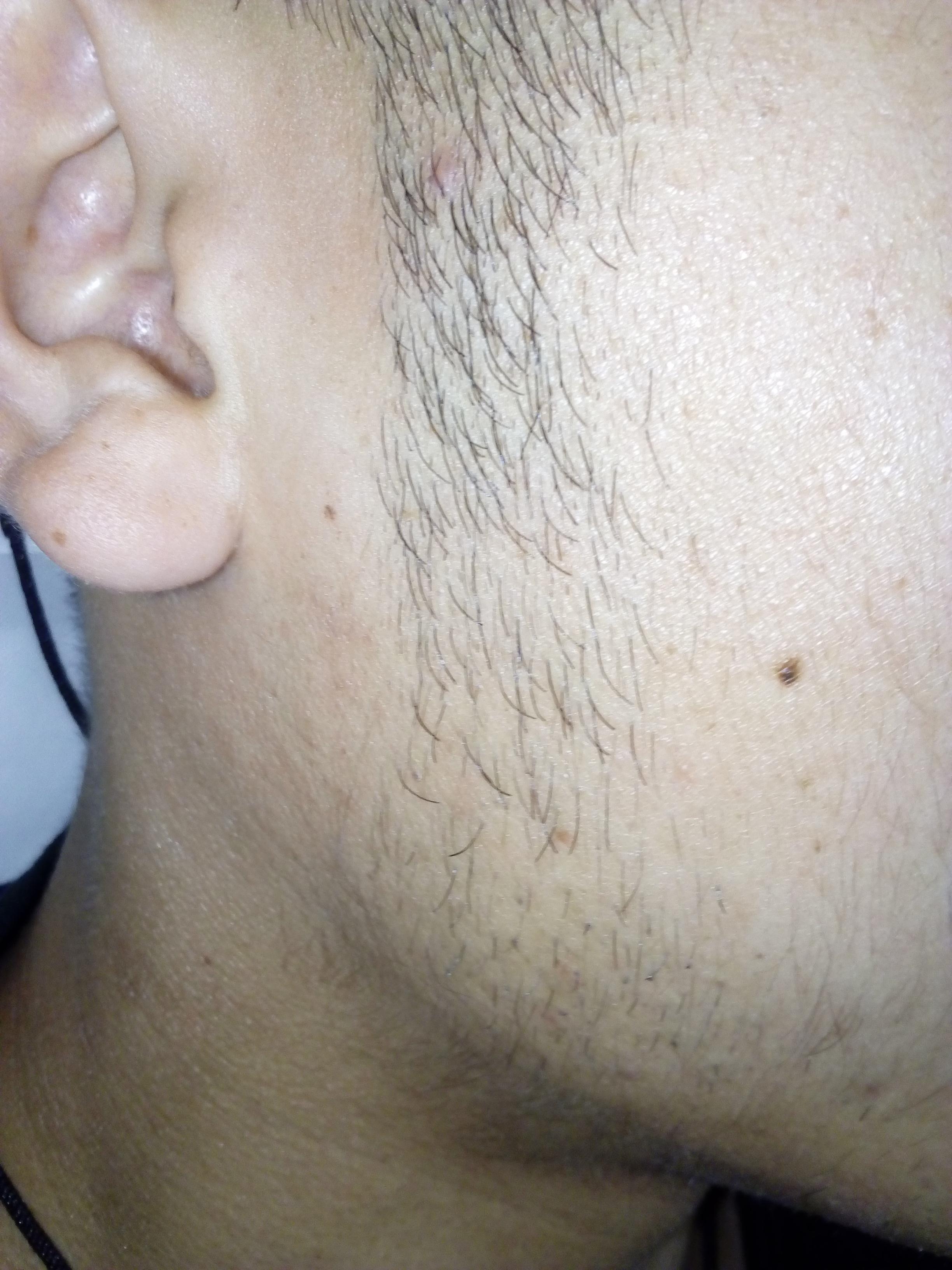 为什么我的脸上都长毛啊是整个脸不是络腮胡可以激光脱毛吗