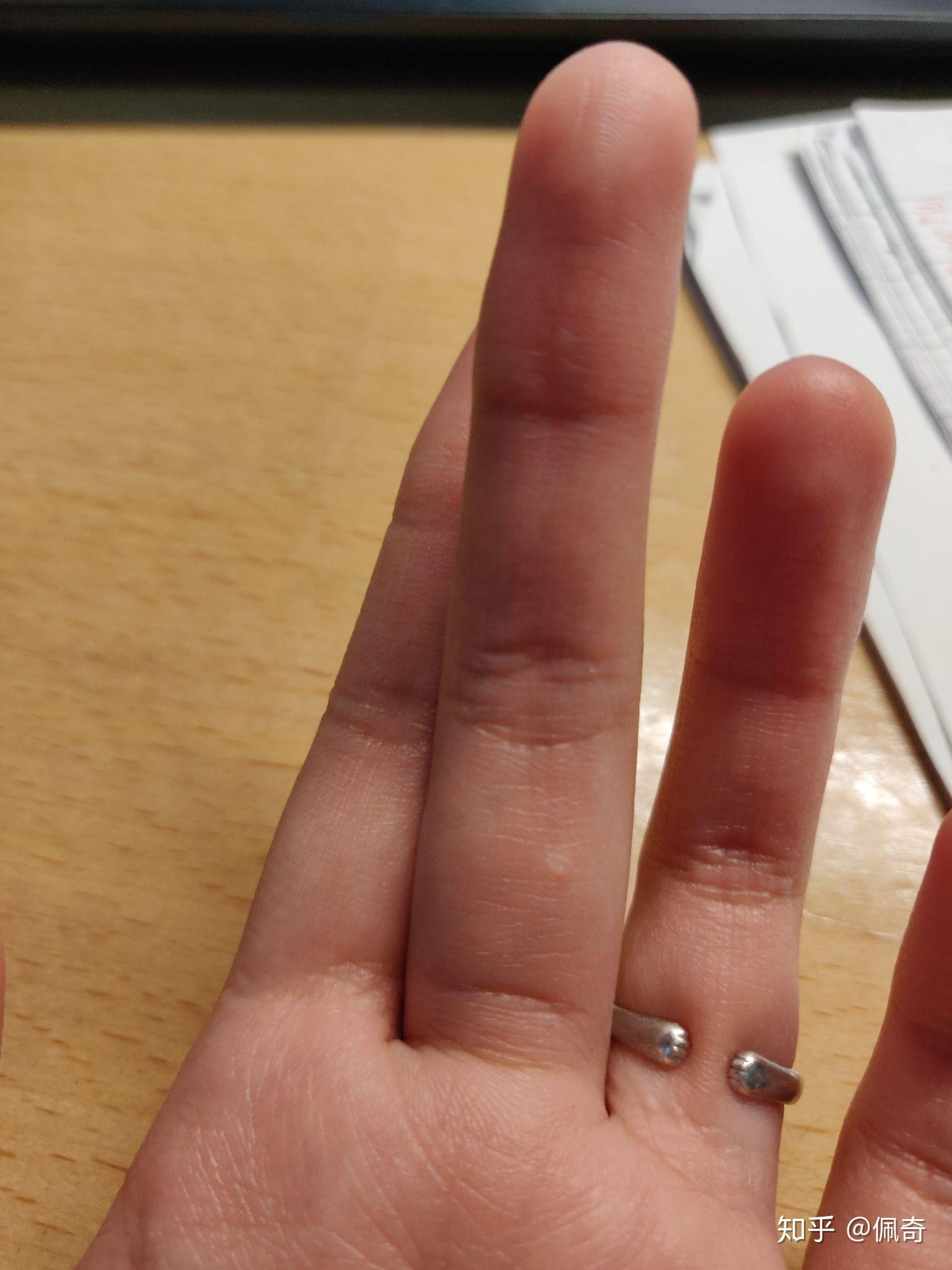 手部皮肤上长了透明小包(小疙瘩),不痛不痒,微硬,请问这是什么?