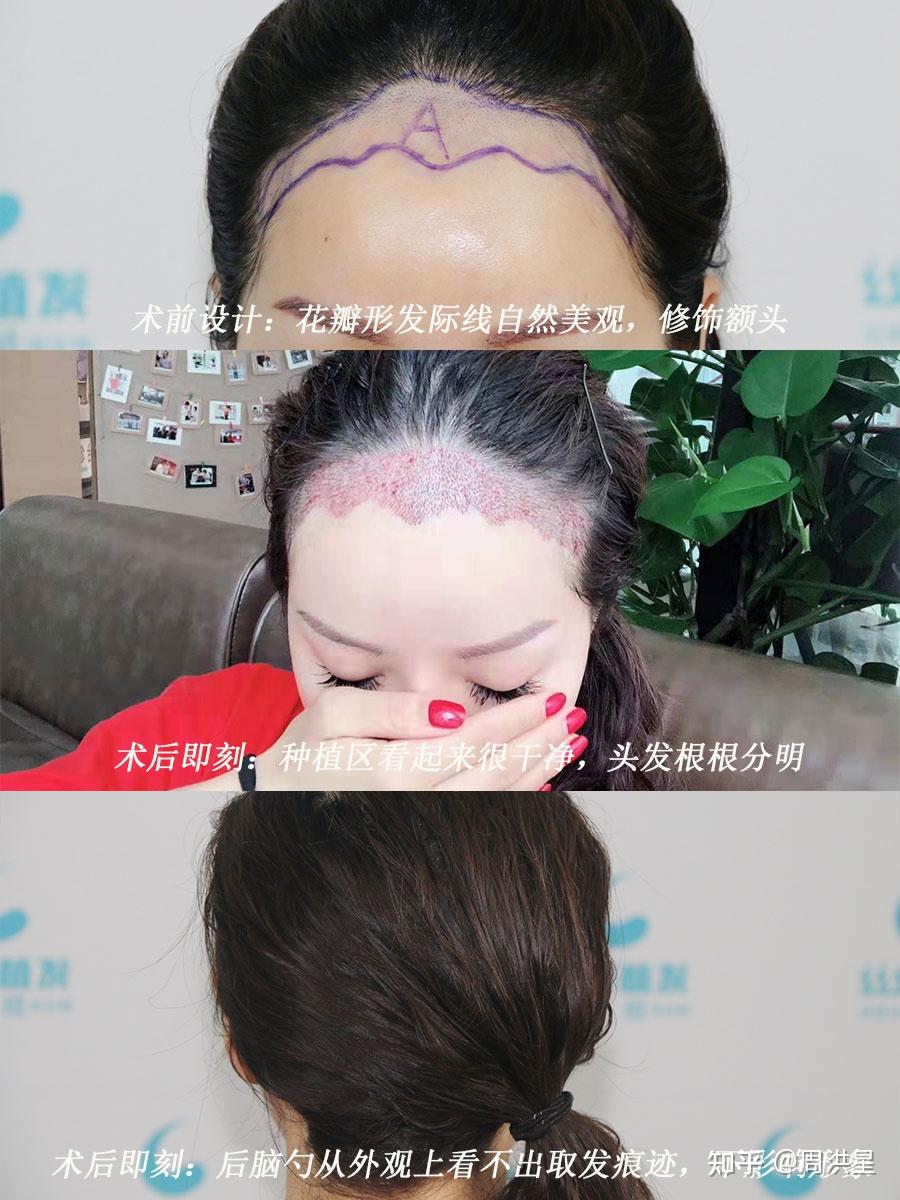 不敢相信，植发前后是同一个人【案例分享】 - 知乎