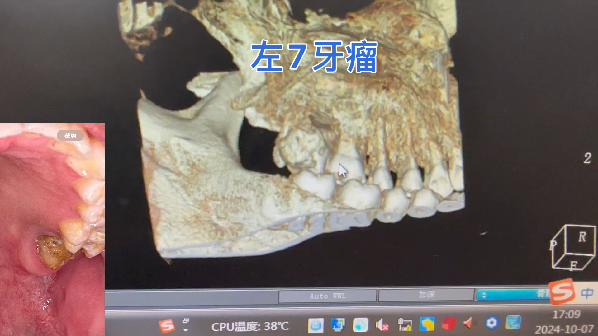 牙瘤有分良性恶性吗?这是牙龈癌吗?