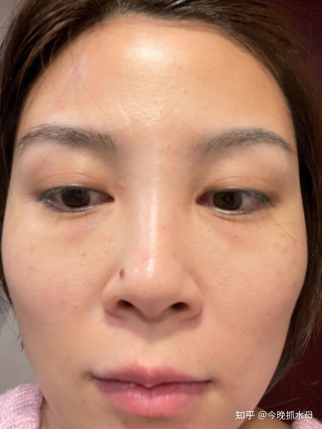 20多岁就长了法令纹,还总是被人说,有什么简单有效去法令纹的办法吗? - 知乎