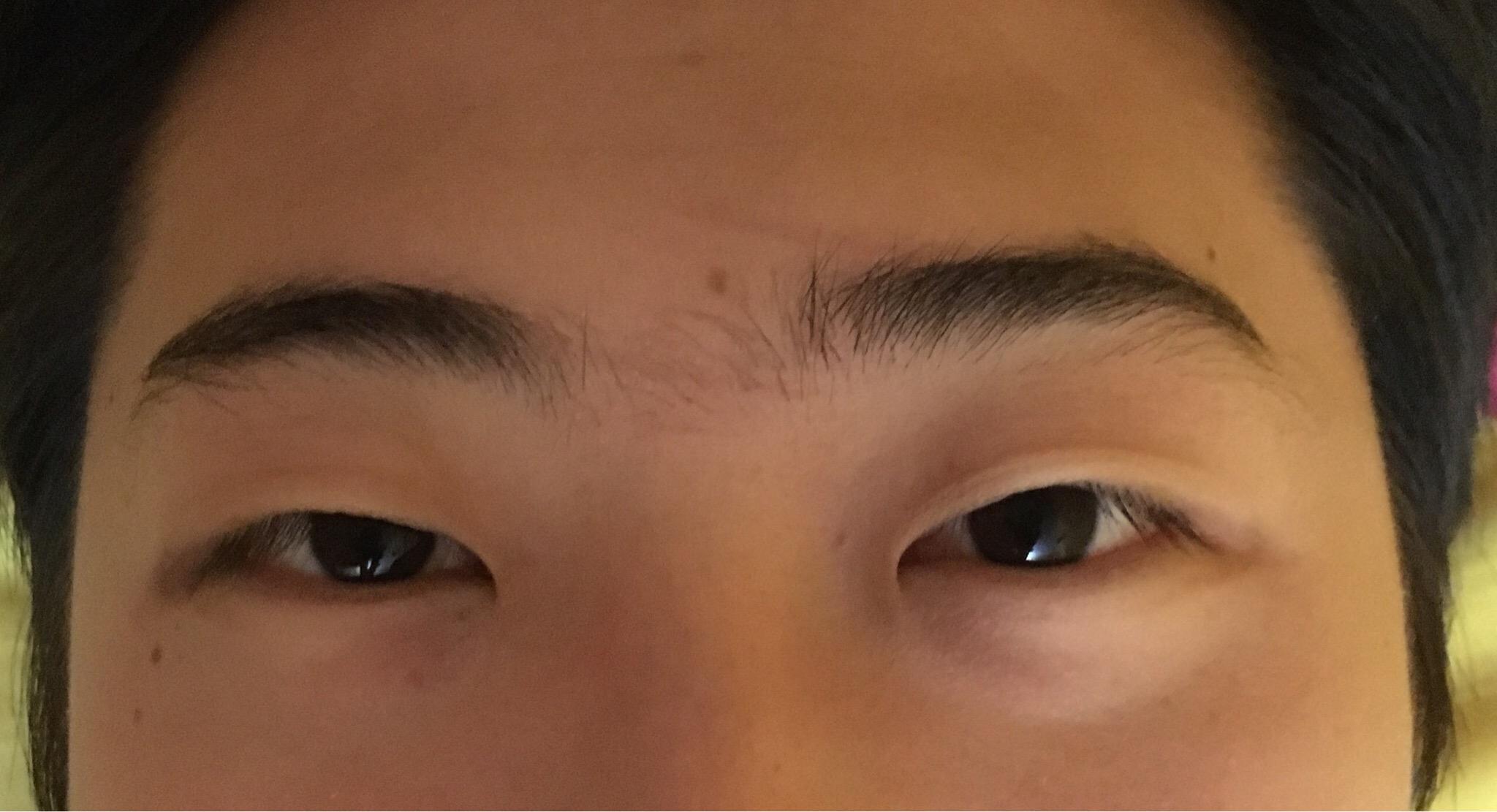 侧面看眼睛非常突眉骨低和鼻子连接不起来是怎么回事