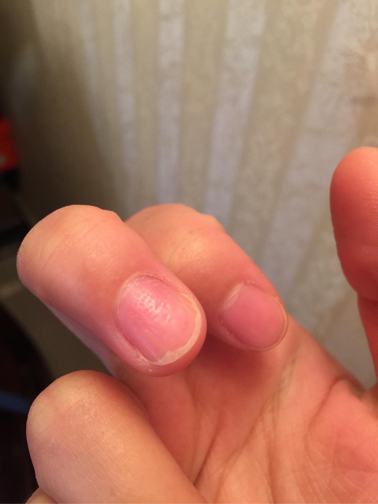 手指甲上全是小坑是怎么回事呢? - 知乎