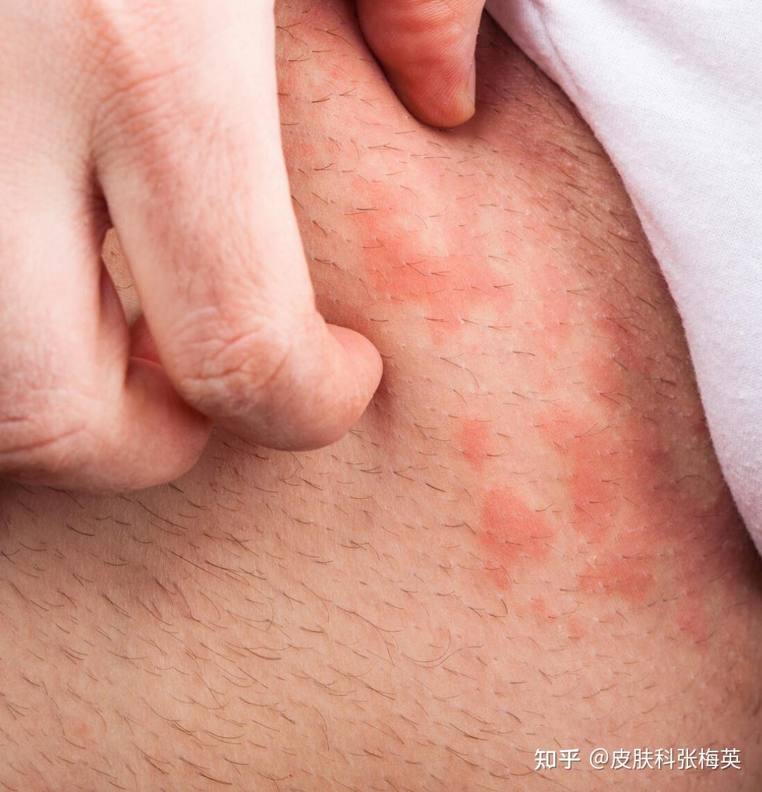 究竟是湿疹还是银屑病？这4个区别，看完你就知道了- 知乎