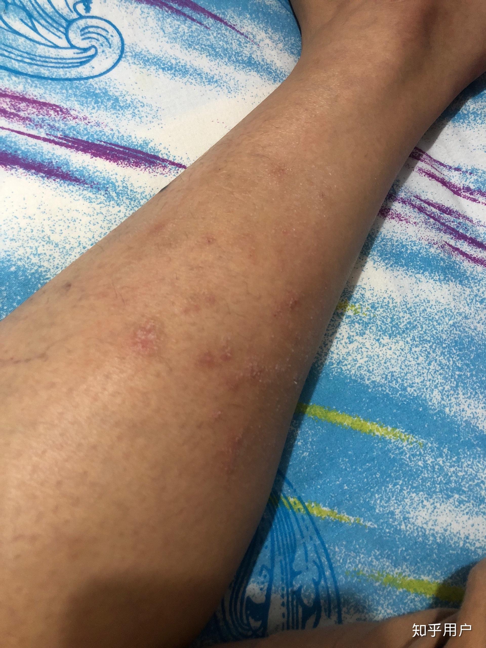 小腿特别痒持续了两个月了一直不好越挠越痒挠破皮结了一腿的疤