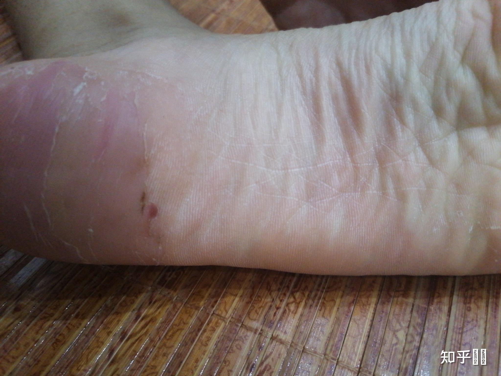 脚老是蜕皮怎么办经常脱皮太难看了如何应对