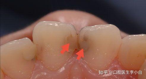 补完牙能用多久,一定会发生继发龋吗? - 知乎