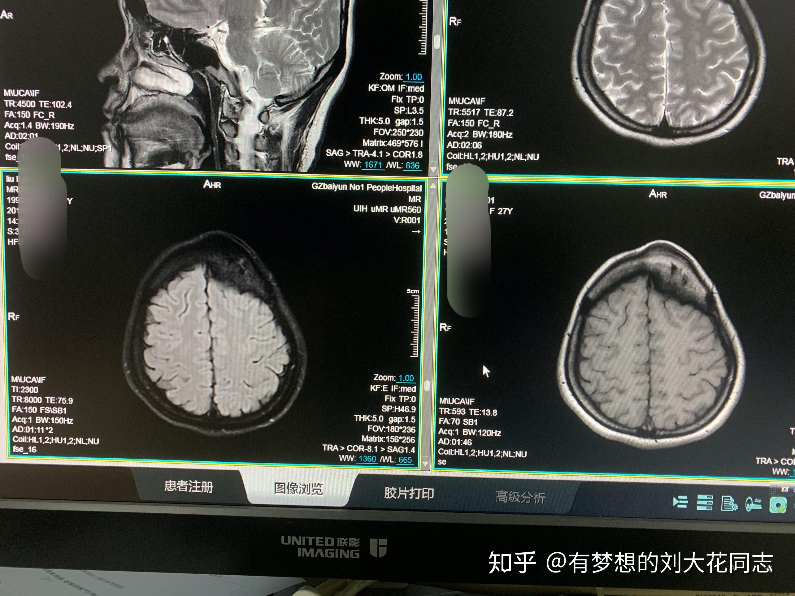 我头上长了一个颅骨骨瘤,专家说没有关系,可是我发现它在缓慢的长大