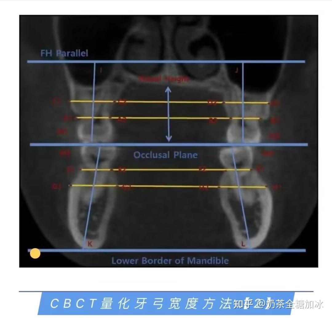 正畸进修之怎么判断牙弓宽度是否存在问题？需不需要扩弓? - 知乎