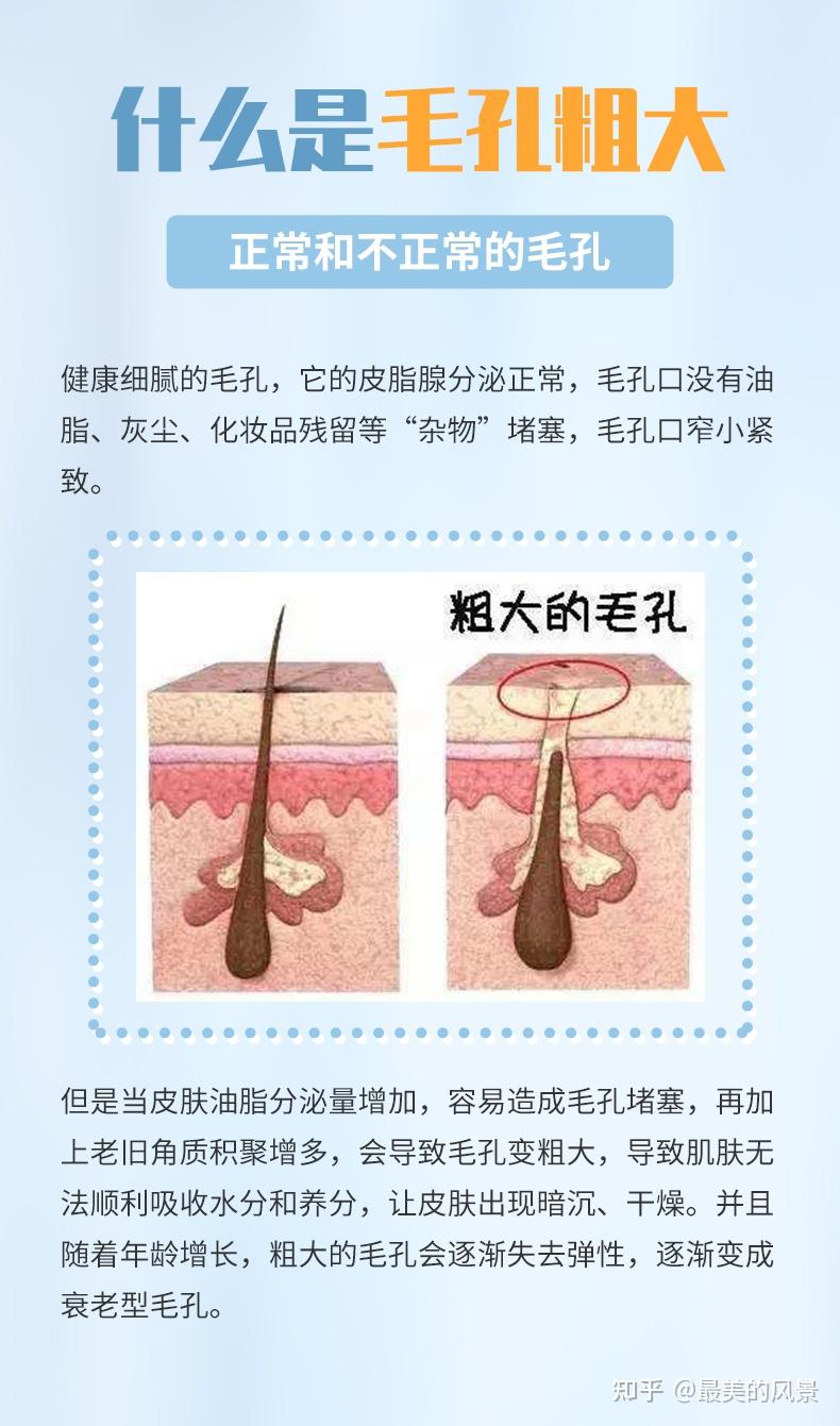 毛孔大得像“筛子”,你的毛孔是怎么一步步撑大的? - 知乎