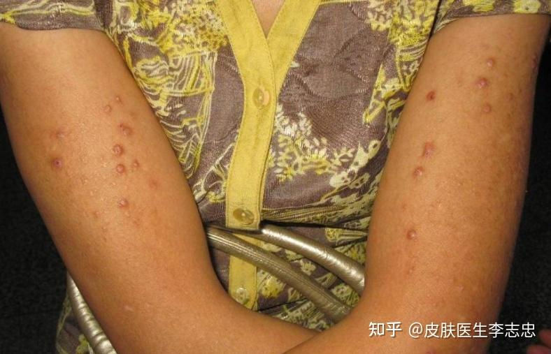 什么是结节性痒疹？中医如何认识和治疗结节性痒疹？ - 知乎