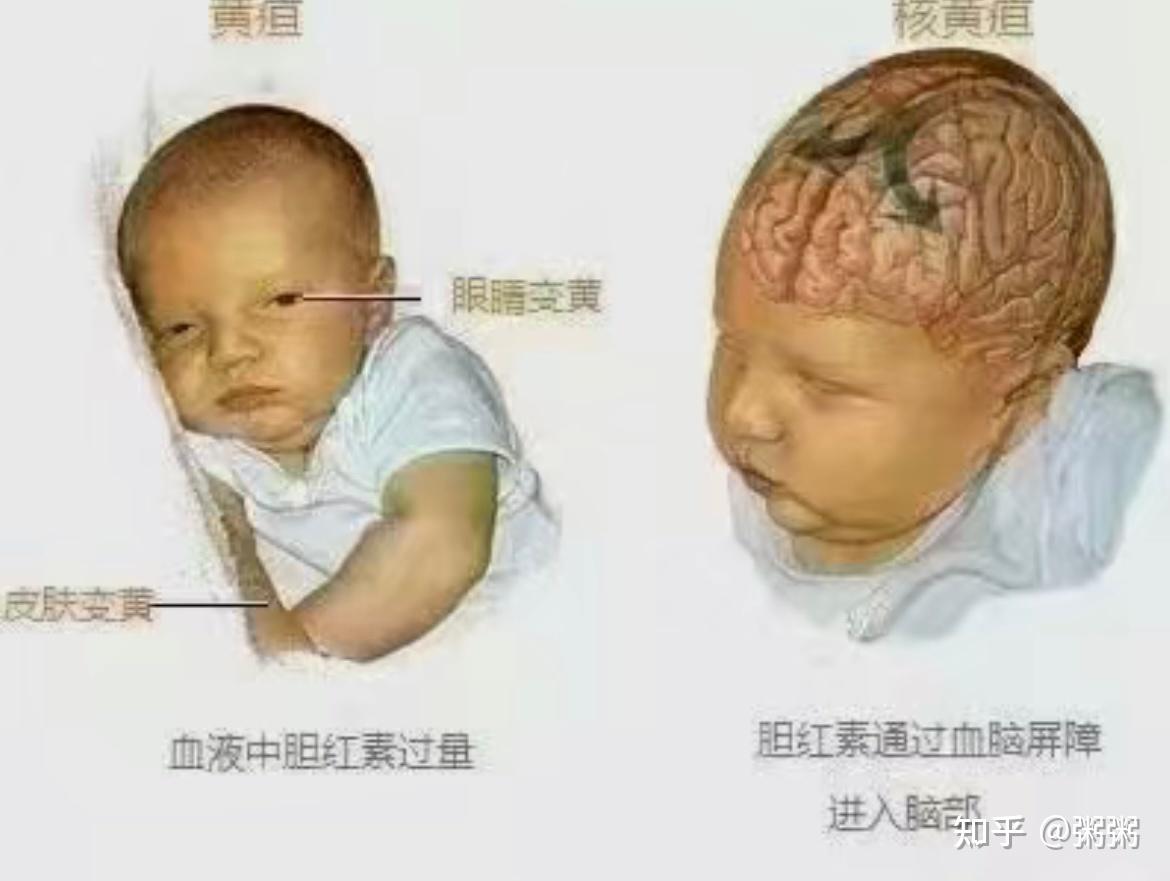 新生儿为什么会有黄疸 - 知乎