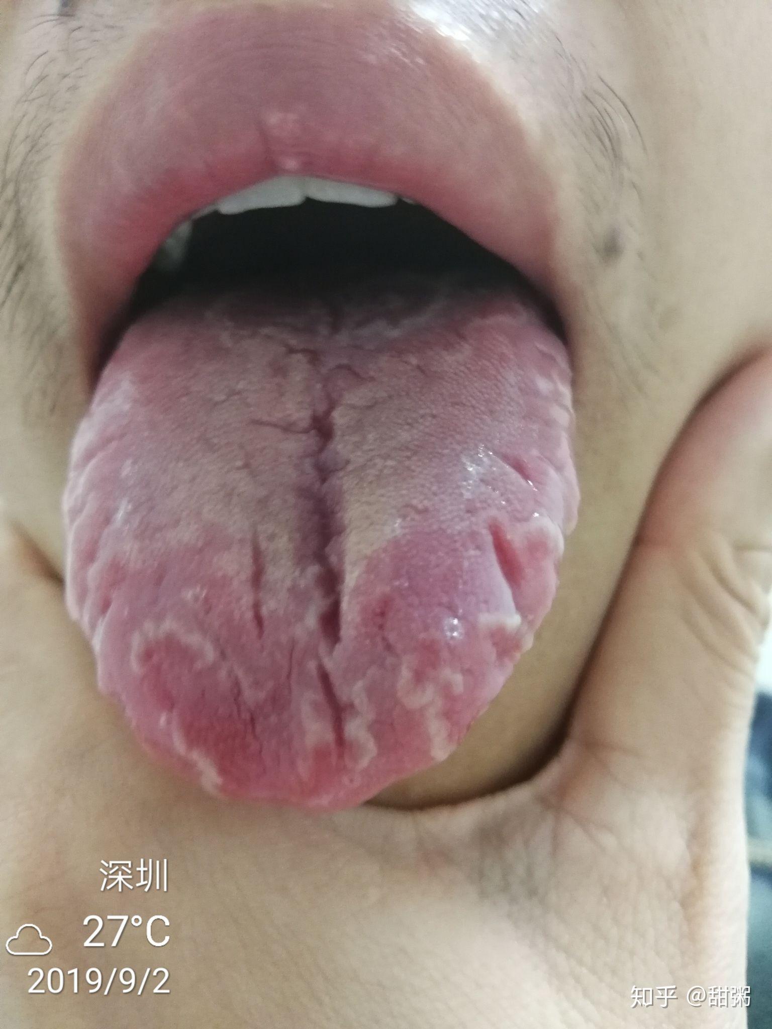 舌苔裂纹病症图片