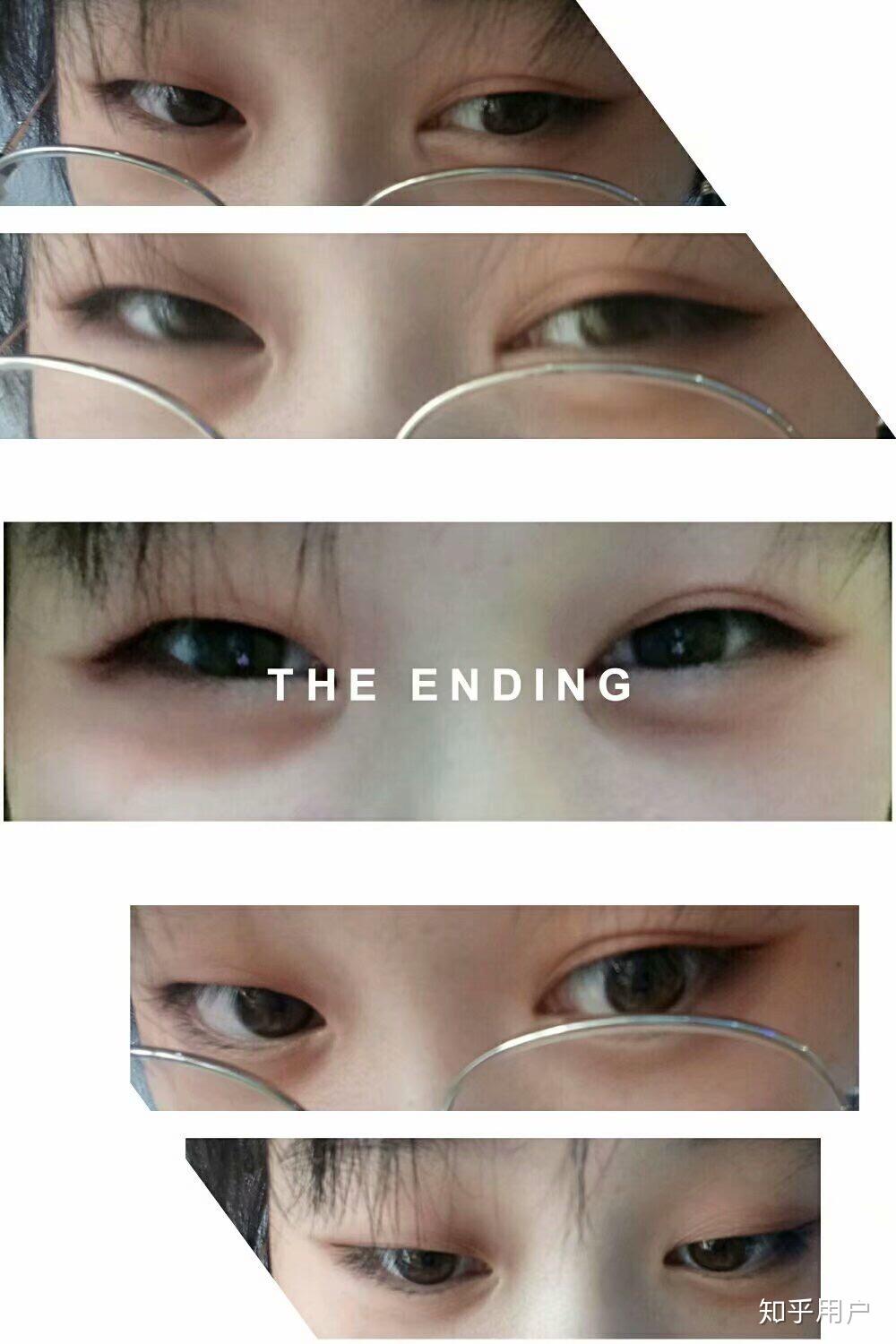 一个单眼皮一个双眼皮是怎样的体验?