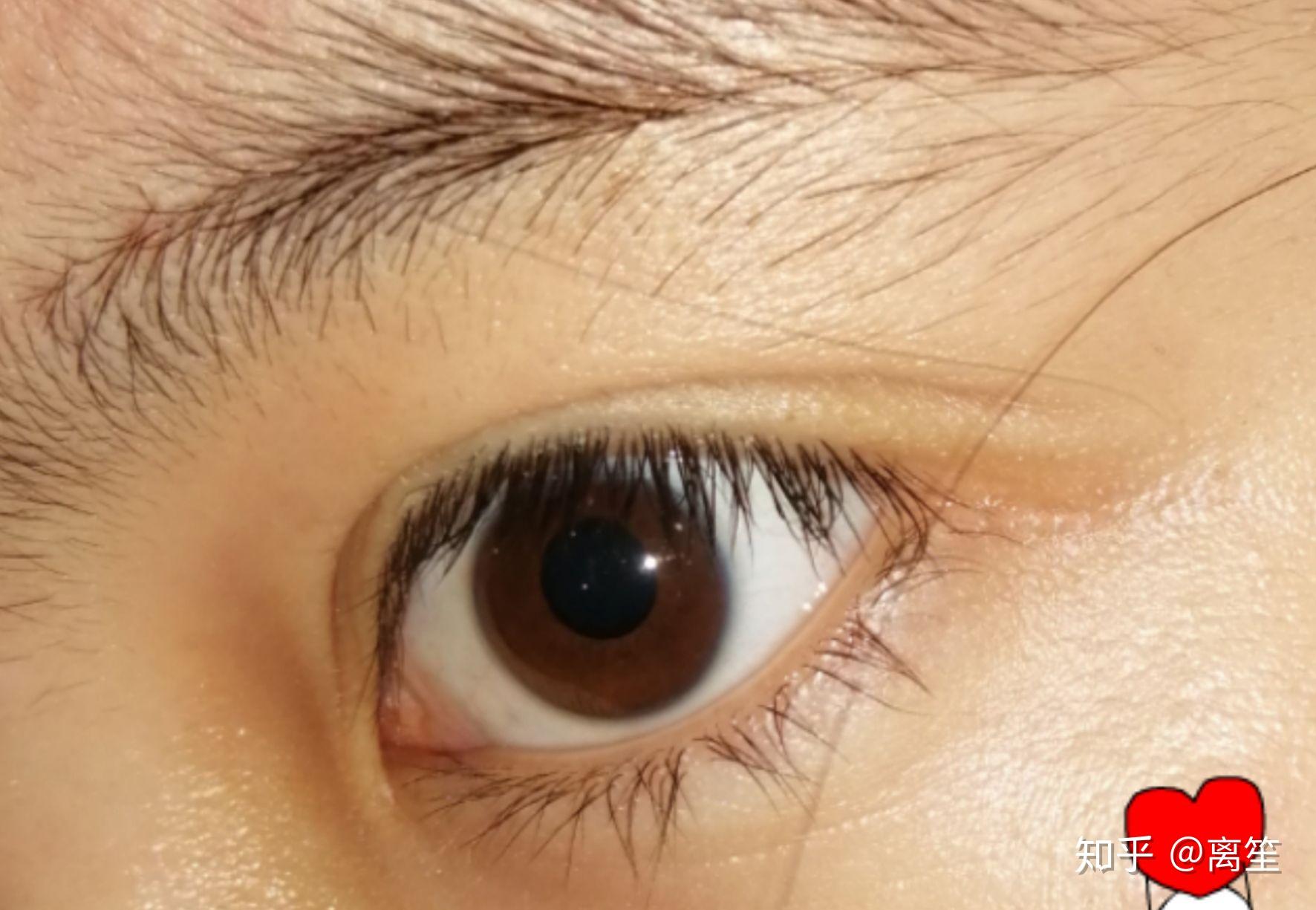 瞳孔放大是怎样的