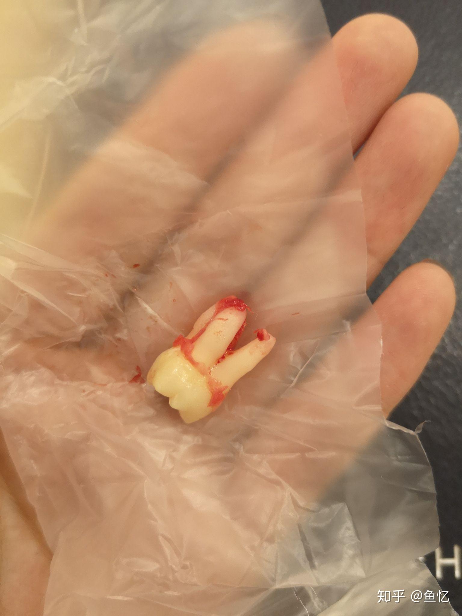 智齿没有长出来到底要不要拔出来? - 知乎