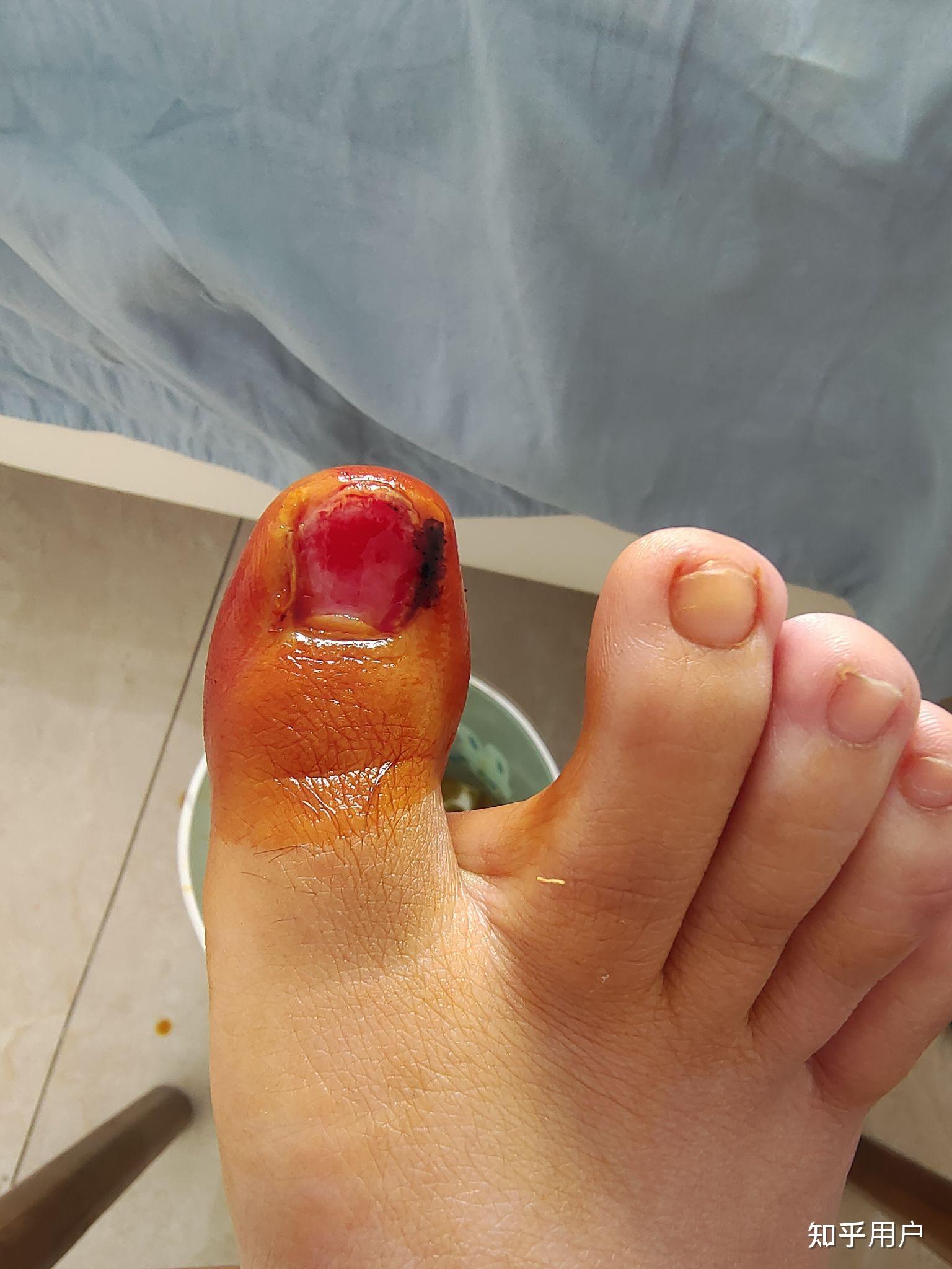 指甲盖掉了是怎样的一种体验? - 知乎