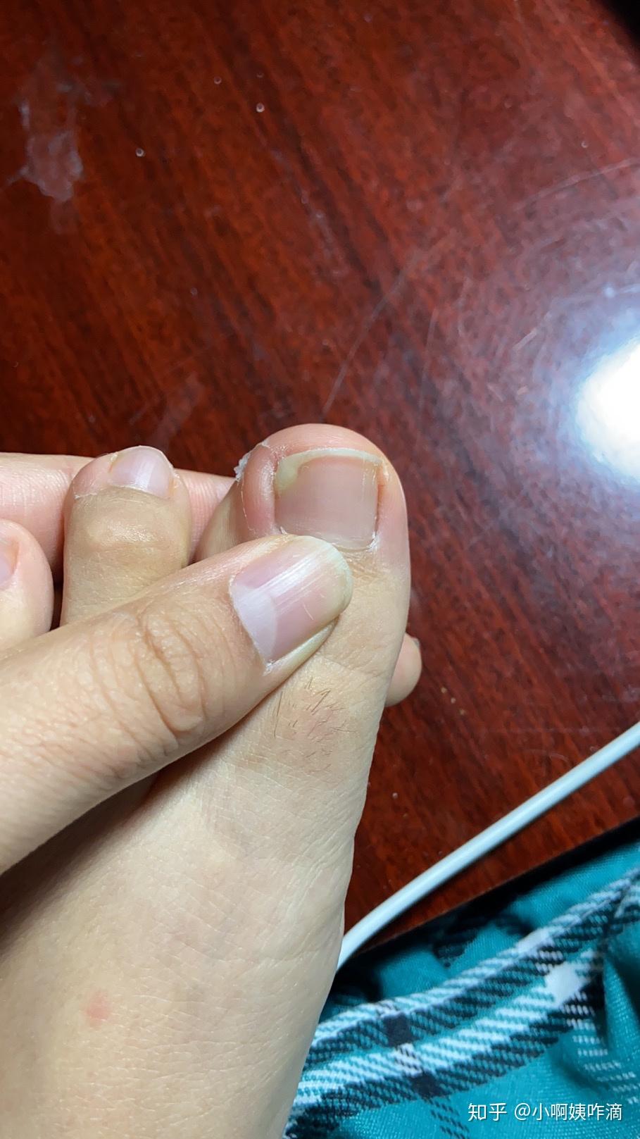 脚趾大拇指指甲两侧往肉里长怎么办啊? - 知乎
