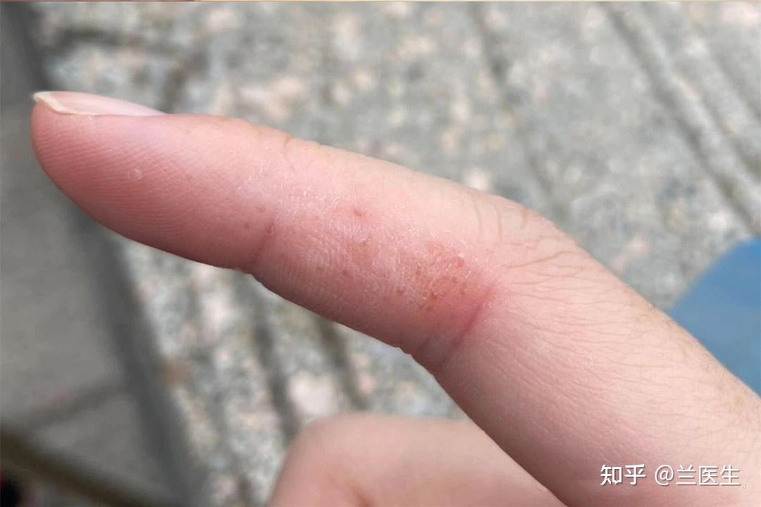 汗疱疹最简单的自愈方法? - 知乎