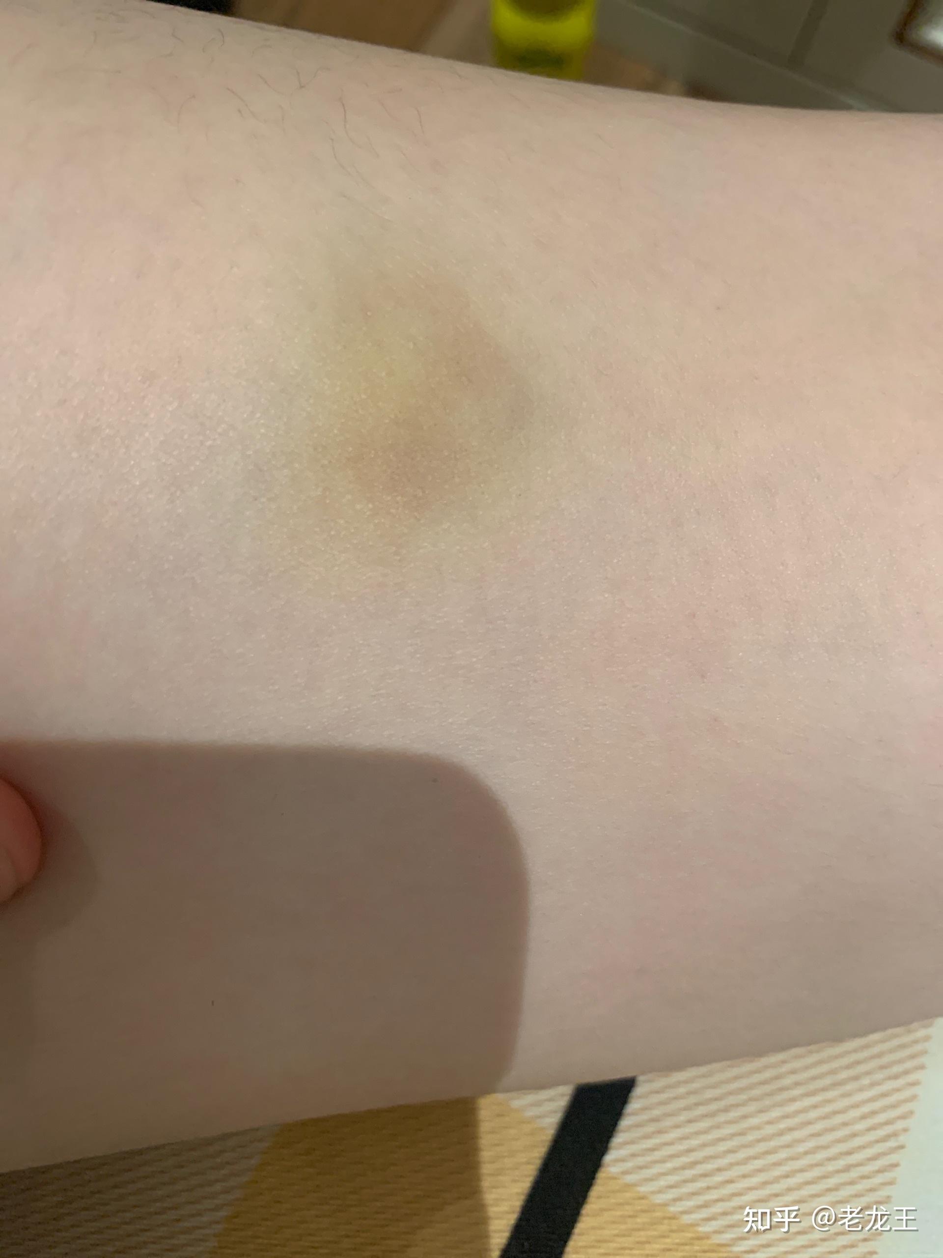 为什么身上莫名其妙有淤青? - 知乎