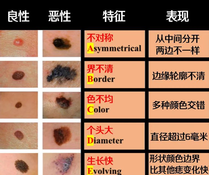 身上这种痣，要不要点？ - 知乎