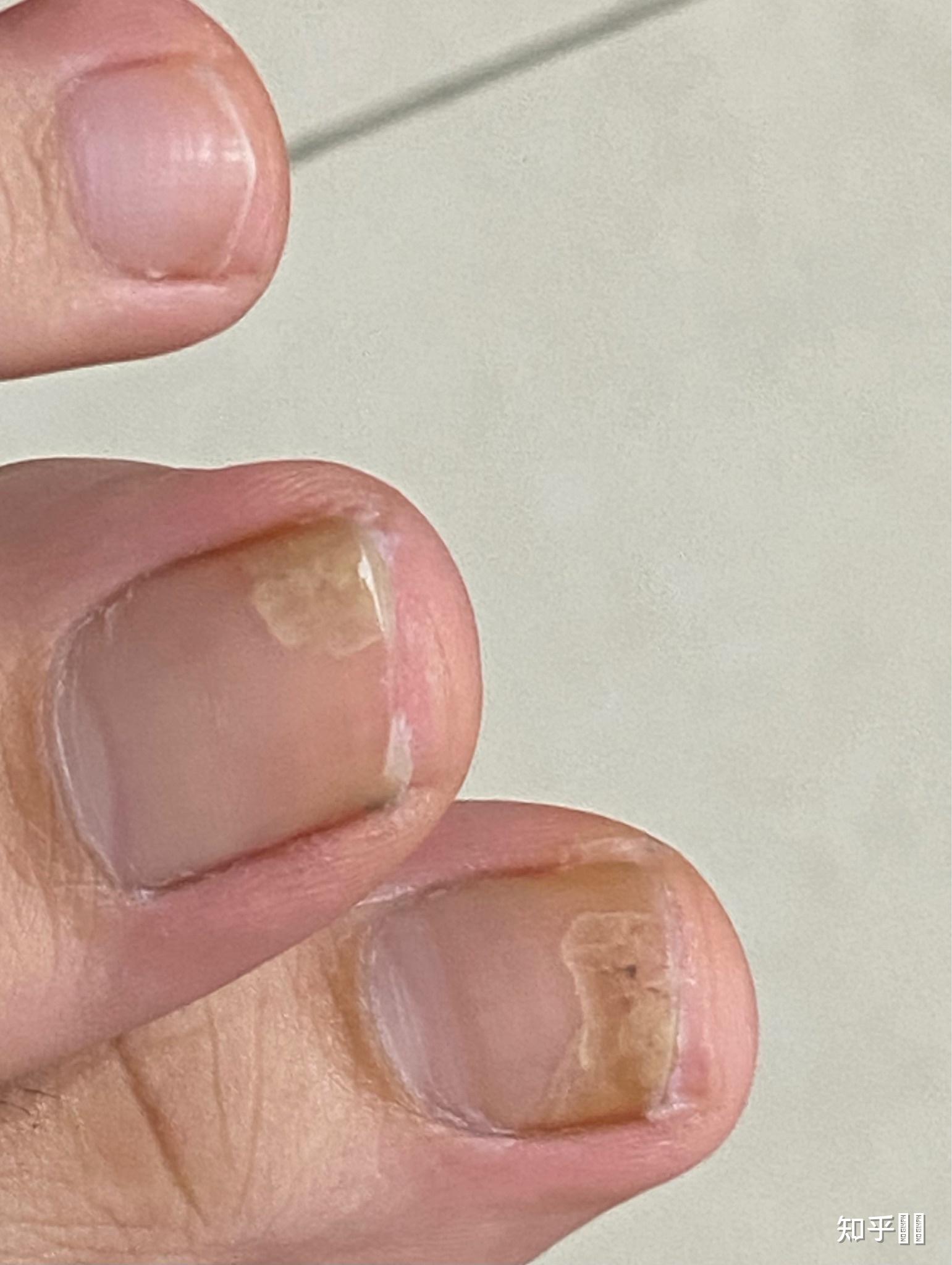 指甲分层初期图片