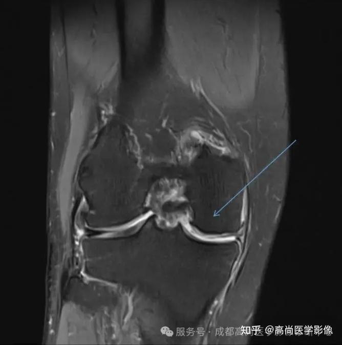 膝关节滑膜皱襞综合征(MPS)MR诊断 - 知乎