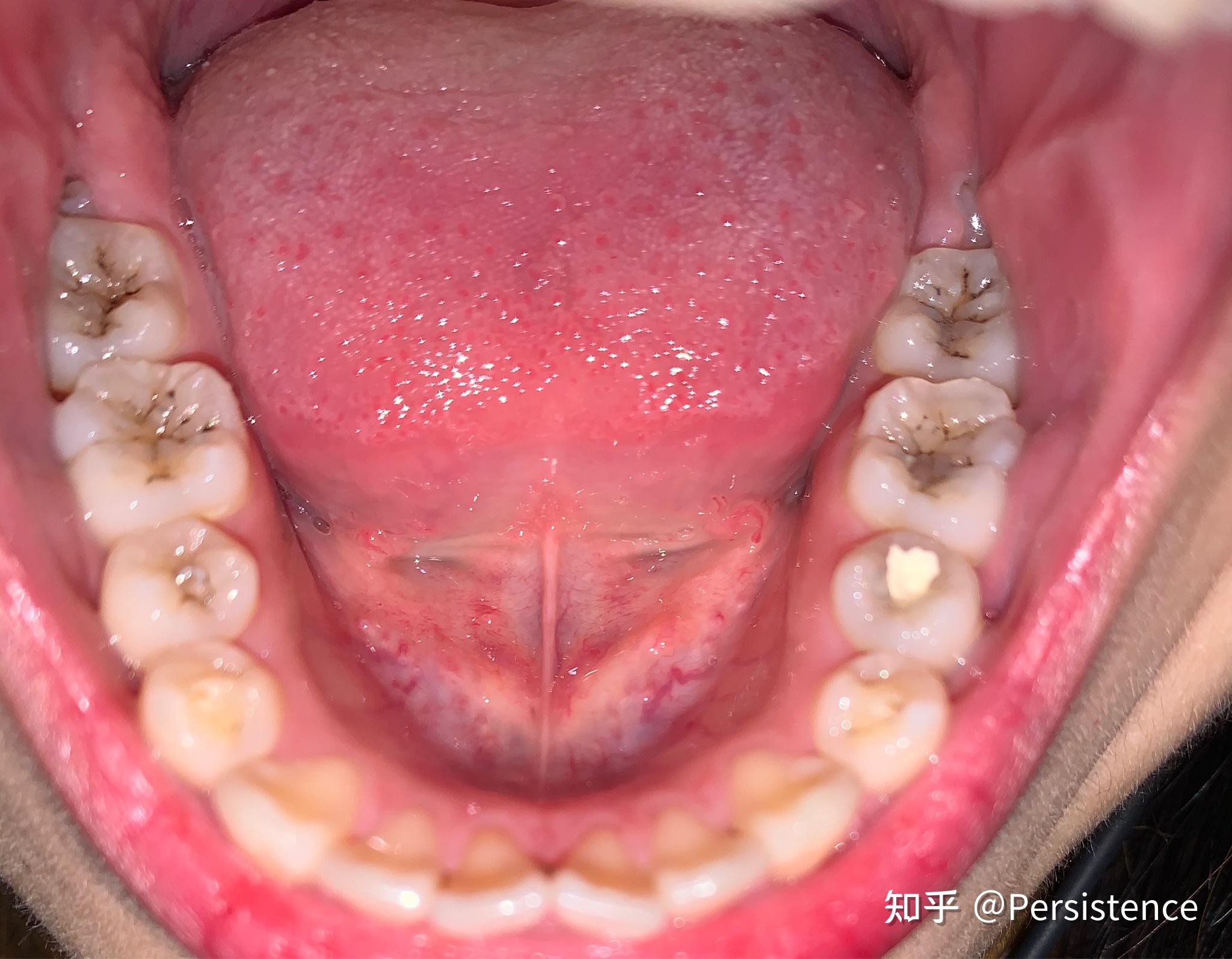 满口蛀牙是什么感觉? - 知乎