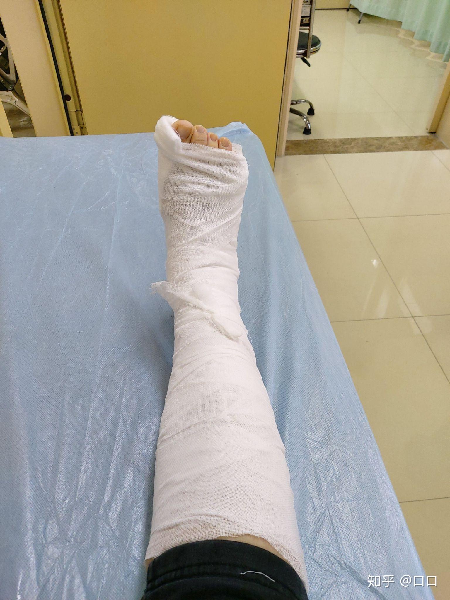 脚踝骨折是一种怎样的体验