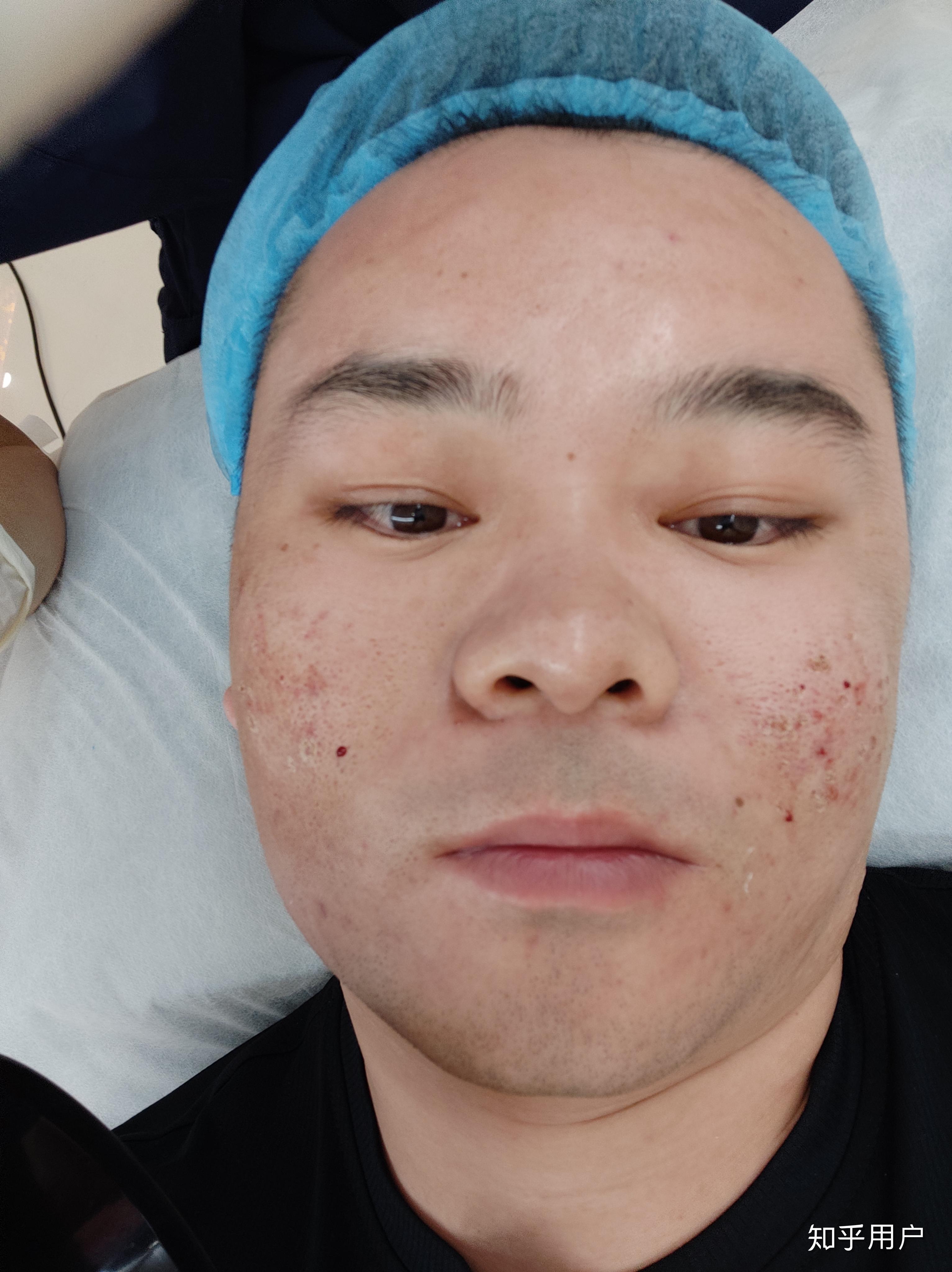 点阵激光去痘坑的效果如何? - 知乎