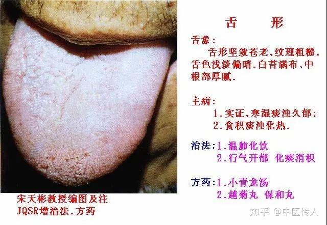 高清舌诊图解:各种临床证型舌象图谱大开眼界 - 知乎