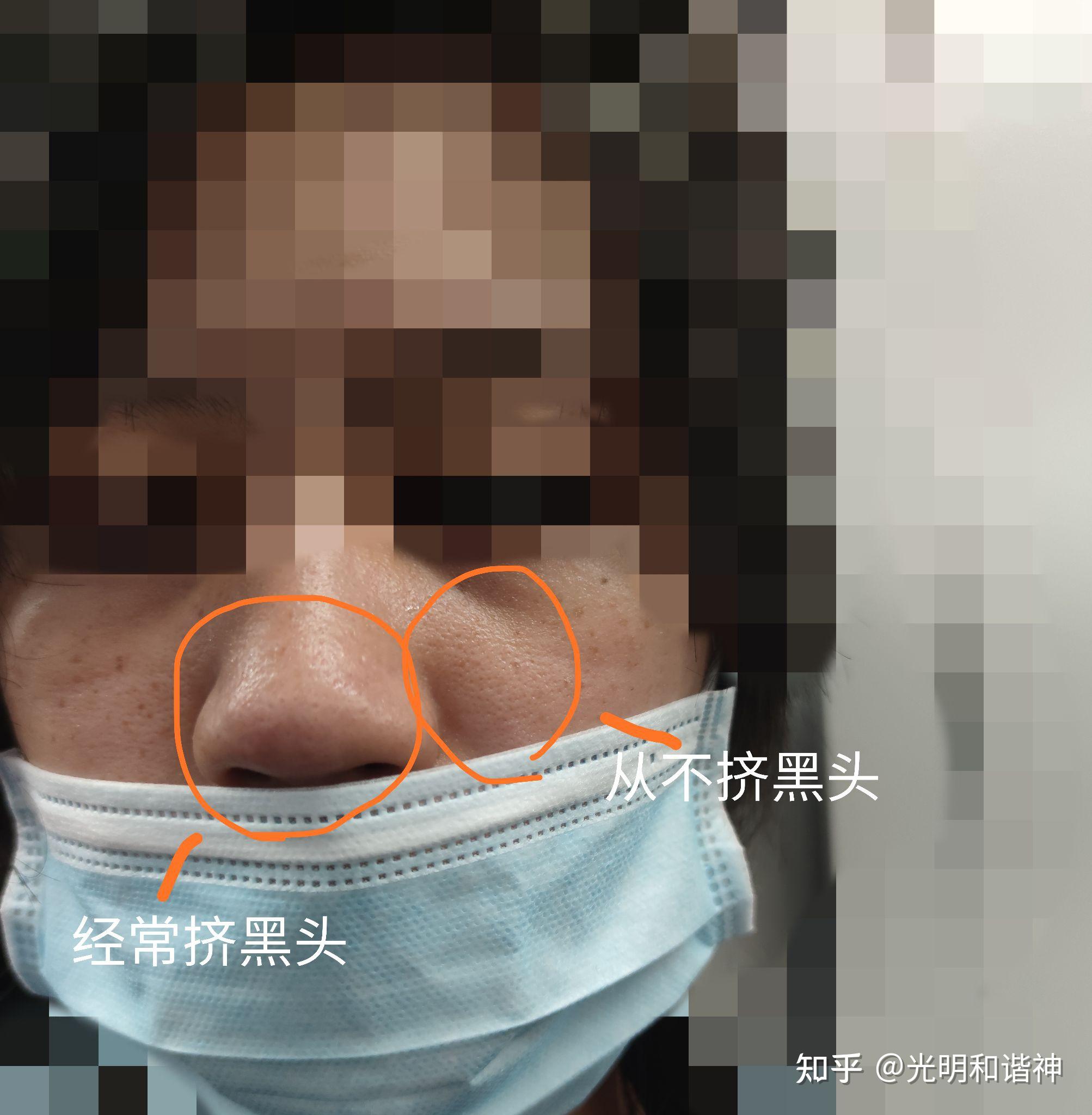 手贱挤黑头挤出一个洞怎么办