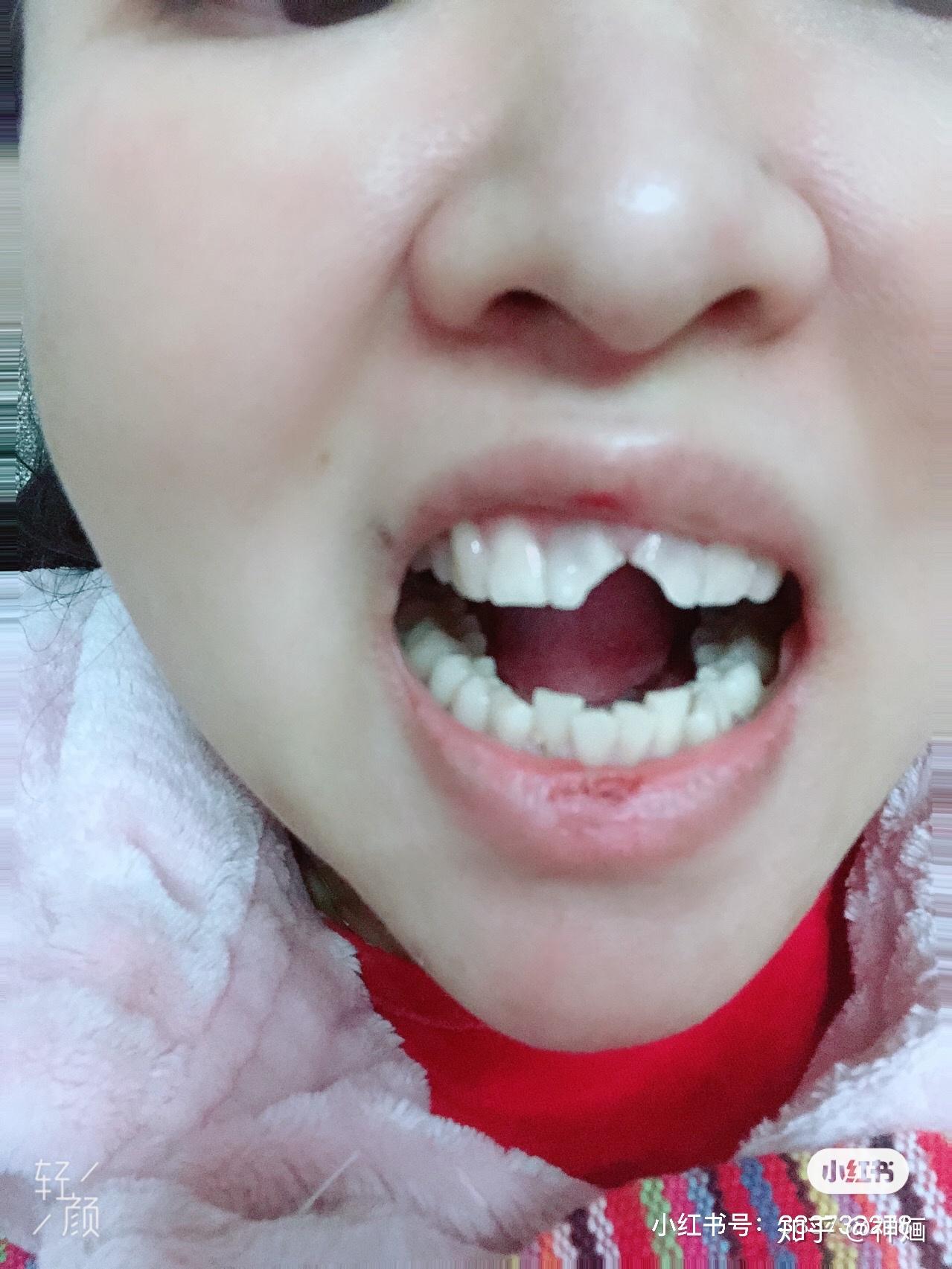门牙磕掉1/6大小的一个角,牙根没受损,是需要补牙还是烤瓷? - 知乎