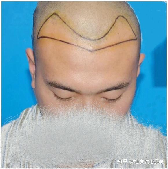 王晶植发(王晶怎么有头发了)