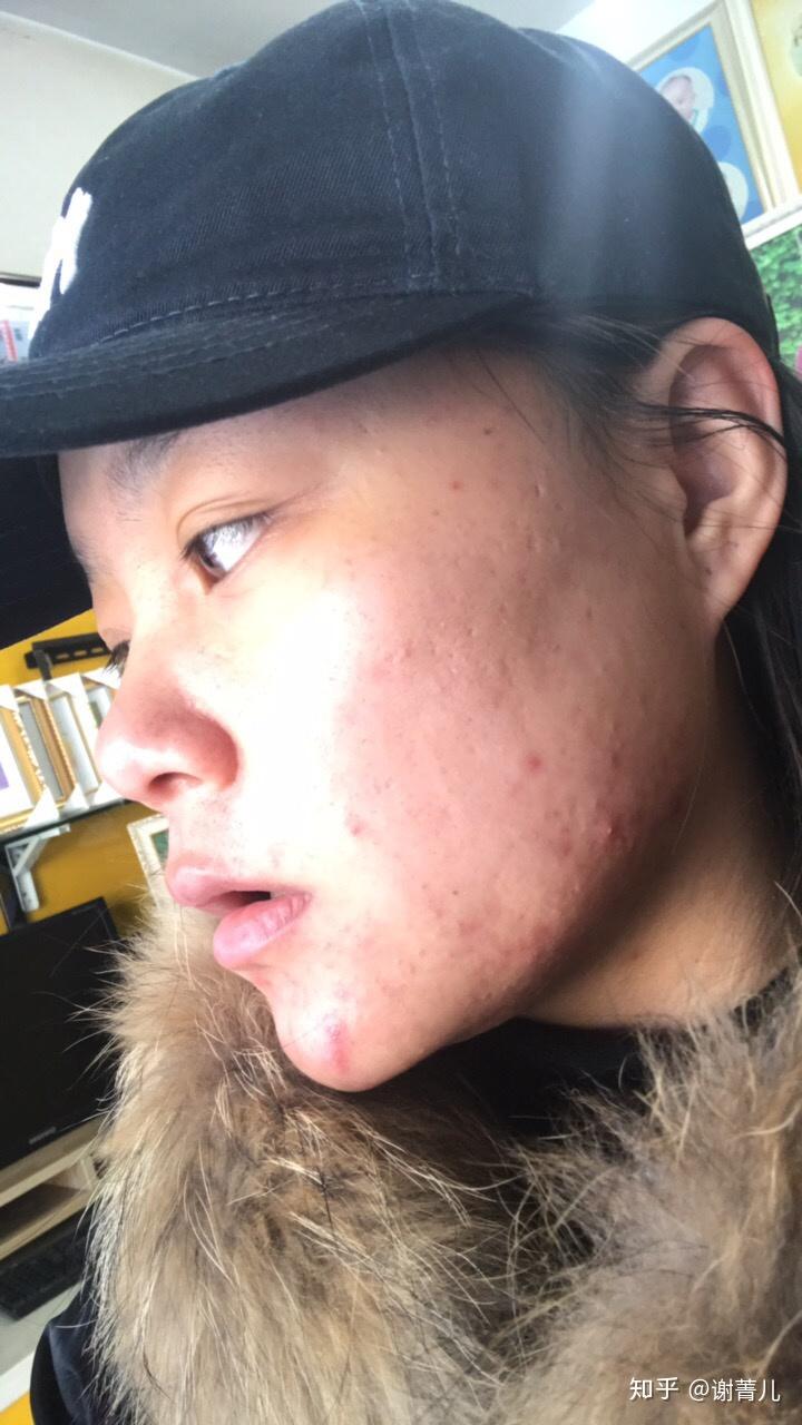 女生皮肤很差毛孔粗大长痘痘怎么办