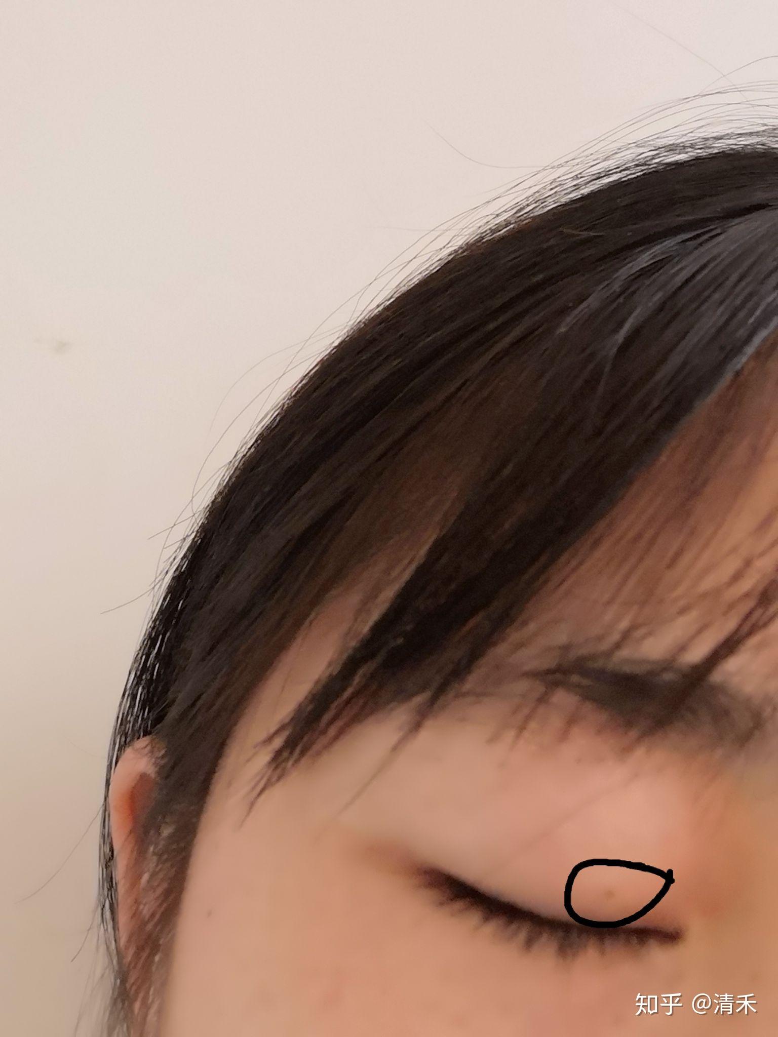 为什么有人说妖痣可怕,妖痣究竟长在哪里? - 知乎