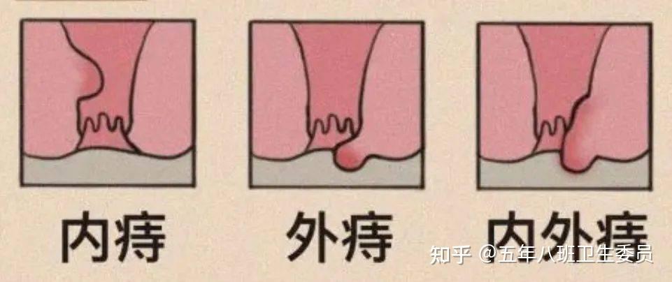 [健康科普]得了痔疮怎么办? 痔的分型和治疗简介 - 知乎