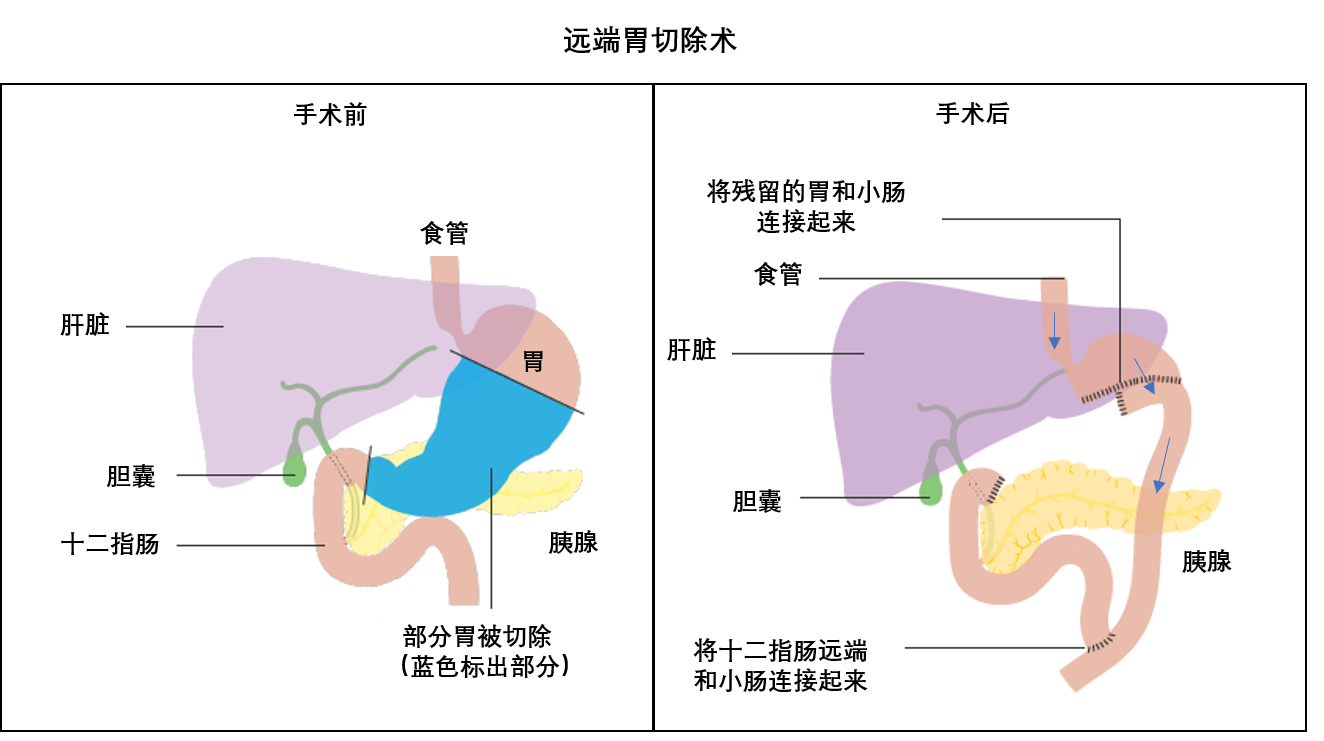胃癌如果把胃全部切除能活多久