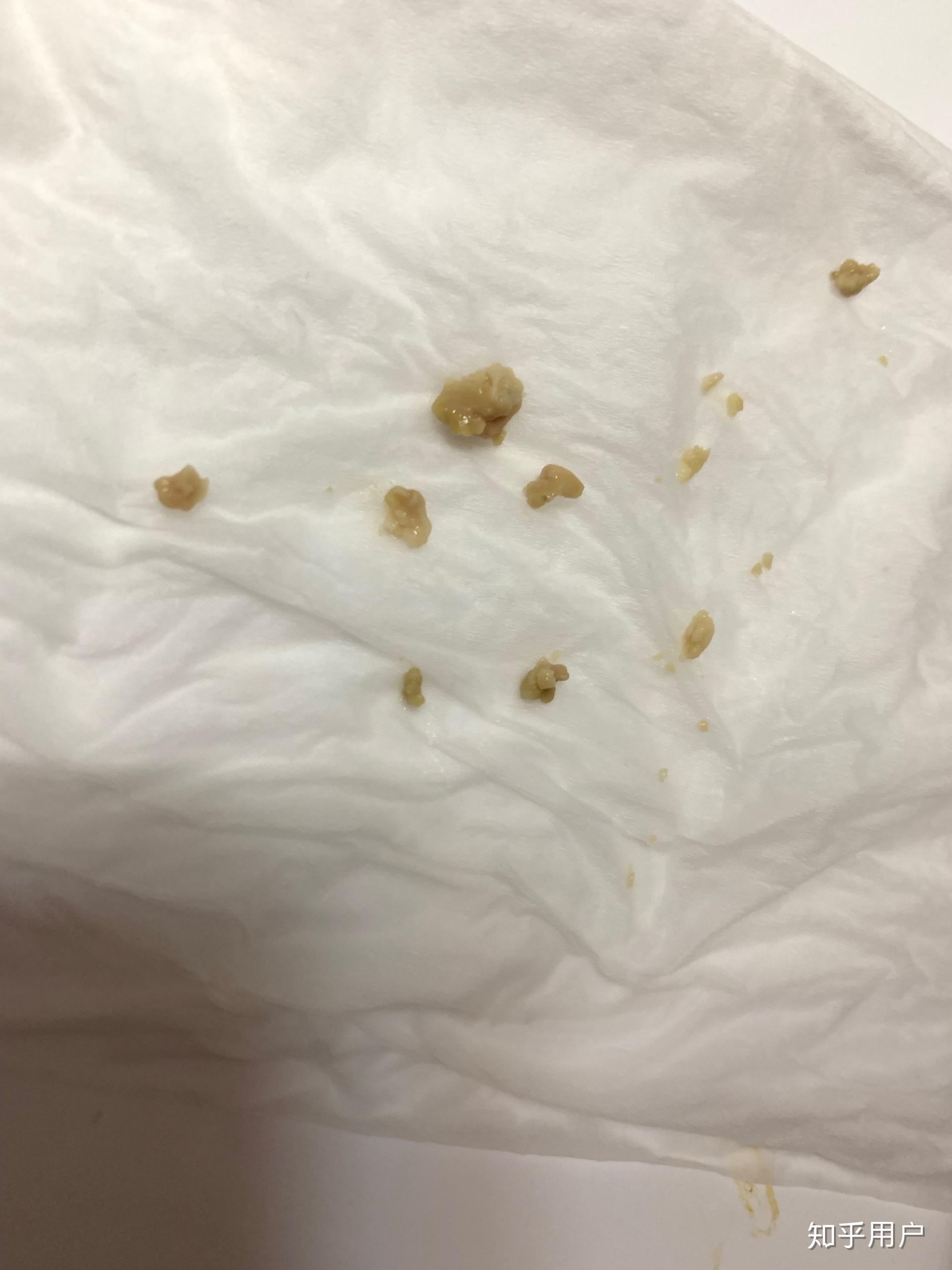 你见过最大的扁桃体结石有多大